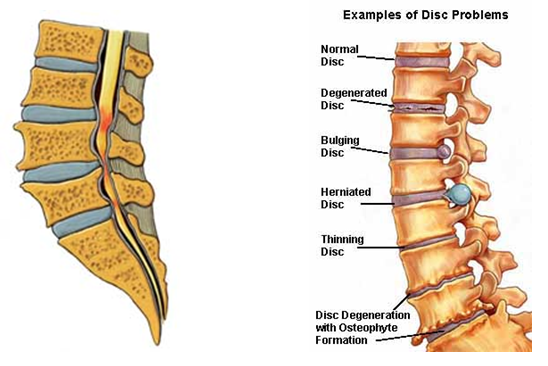 Spinal Stenosis Treatment in Mumbai by Dr. Vishal Kundnani