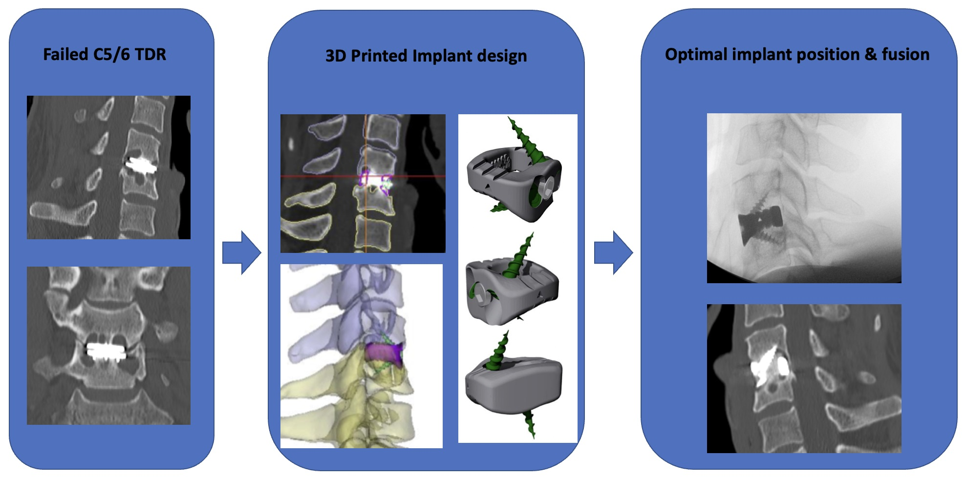Custom 3D Tailor-Made Spine Implants