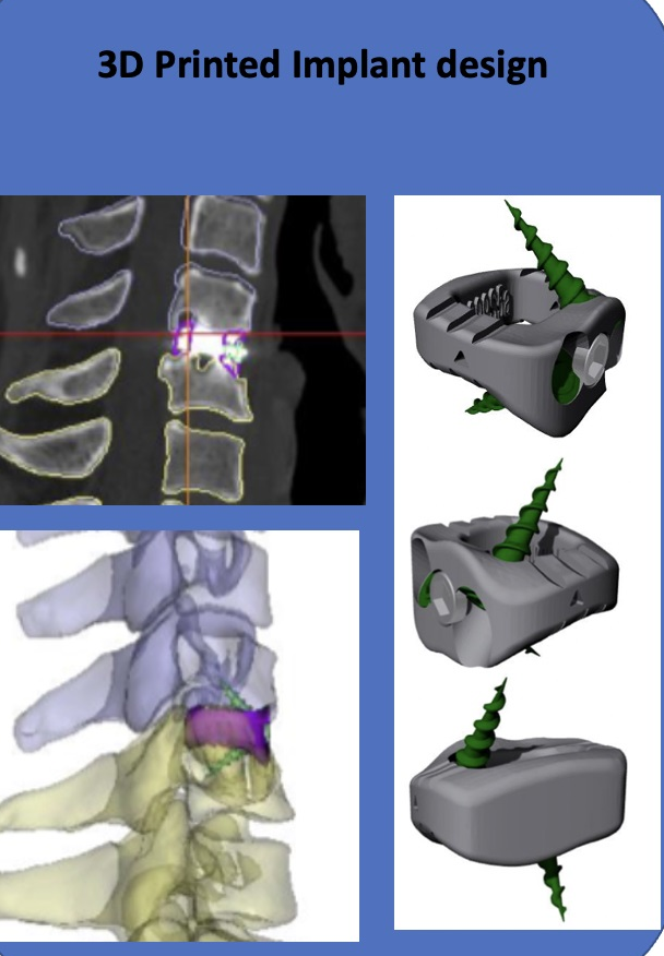 Custom 3D Tailor-Made Implants: Personalized Solutions for Complex Spine Cases