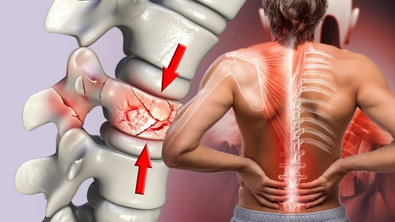 Osteoporosis & Spine Fractures Treatment