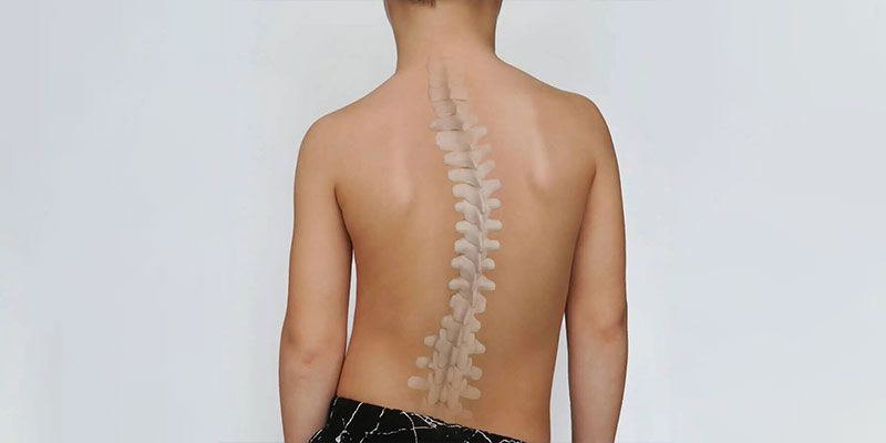Early Signs of Scoliosis