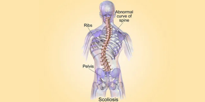 Scoliosis Treatment in India